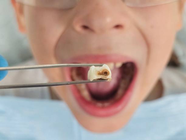 Best Chipped Tooth Repair Near Me  in Hazleton, PA